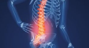 Gai xương cột sống thắt lưng, một biểu hiện của thoái hóa cột sống