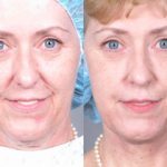 Xóa nếp nhăn trên mặt bằng phương pháp plasma năng lượng thấp