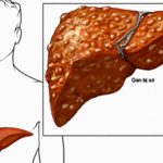 Dấu hiệu sớm của bệnh xơ gan