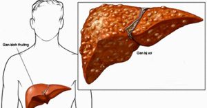 Dấu hiệu sớm của bệnh xơ gan
