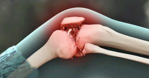 Xử trí đúng cách khi gặp nạn gây đứt chi