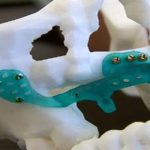 Ca phẫu thuật ghép xương hàm in 3D đầu tiên trên thế giới