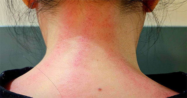 Bác sĩ chỉ ra những người không nên cạo gió